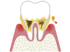 歯周炎（中度）