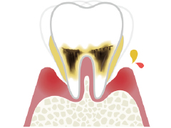 歯周炎（重度）